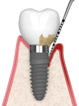 3d render of healthy implant versus implant with peri implantitis Illustrazione stock