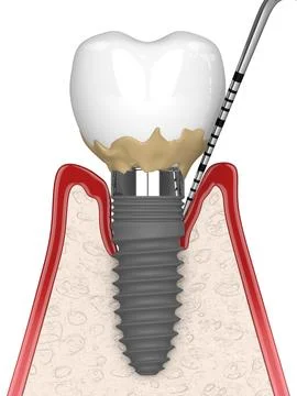 3d render of human gums cross-section with peri implantitis disease and per.. Illustrazione stock