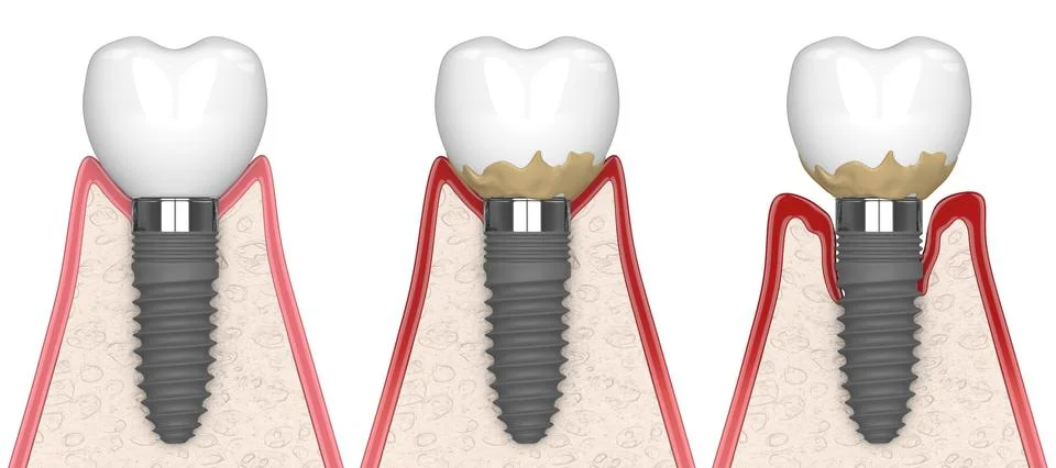 3d render of human gums cross-section with peri implantitis disease Stock Illustration