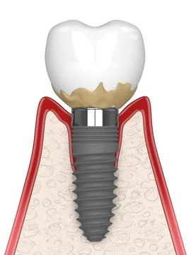 3d render of human gums cross-section with peri implantitis disease Stock-Illustration