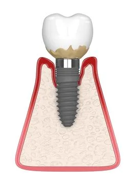 3d render of human gums cross-section with peri implantitis disease Stock Illustration