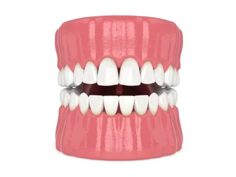 3d render of human jaw with black triangles Stock Illustration