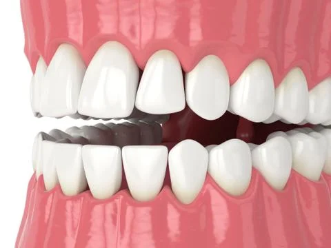 3d render of human jaw with black triangles Stock Illustration