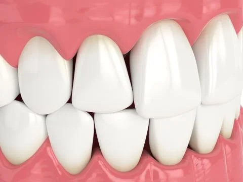 3d render of human jaw with black triangles Stock Illustration