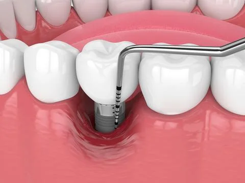 3d render of human jaw closeup with peri implantitis disease and periodonta.. Stock Illustration