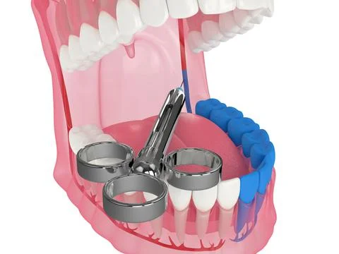 3d render of human jaw with inferior alveolar nerve block technique Stock Illustration