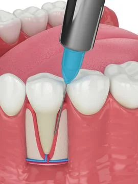 3d render of human jaw with intraligamentary anesthesia procedure Stock Illustration