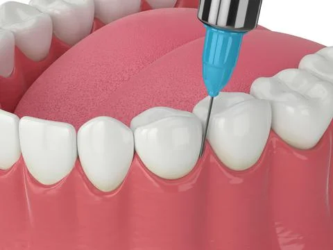 3d render of human jaw with intraligamentary anesthesia procedure Illustrazione stock
