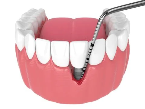 3d render of human jaw with peri implantitis disease and periodontal sonda Stock Illustration