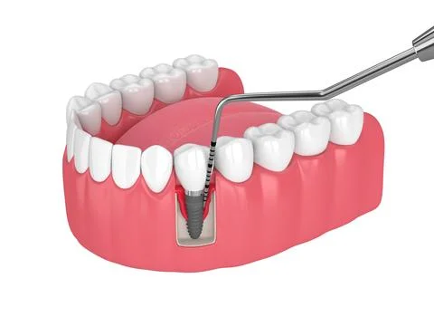 3d render of human jaw with peri implantitis disease and periodontal sonda Stock Illustration