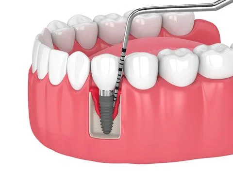 3d render of human jaw with peri implantitis disease and periodontal sonda Stock Illustration