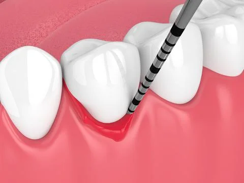 3d render of human jaw with peri implantitis disease and periodontal sonda Stock Illustration
