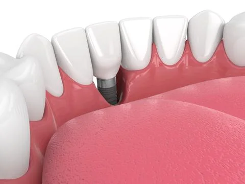 3d render of human jaw with peri implantitis disease Stock-Illustration