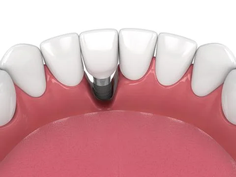 3d render of human jaw with peri implantitis disease Illustrazione stock