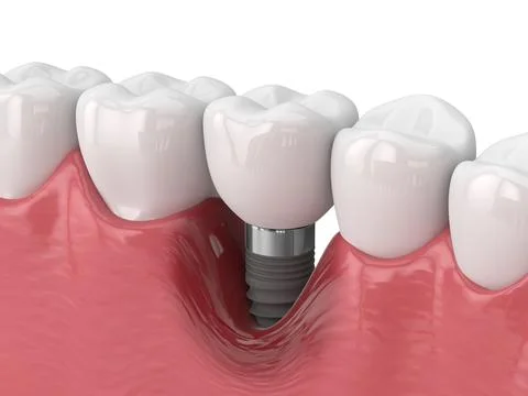 3d render of human jaw with peri implantitis disease Illustrazione stock