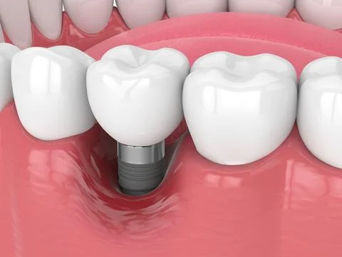 3d render of human jaw with peri implantitis disease Stock Illustration