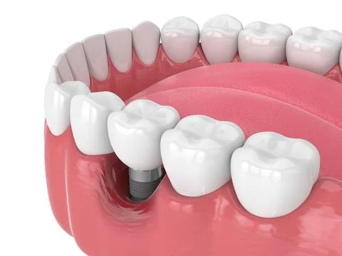 3d render of human jaw with peri implantitis disease Stock Illustration