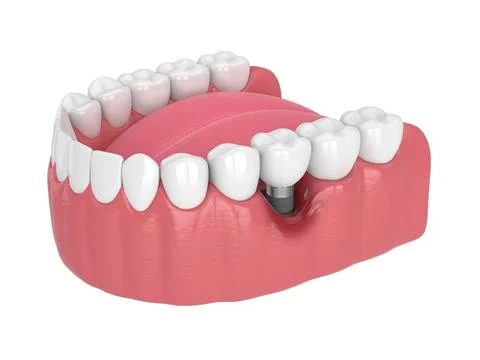 3d render of human jaw with peri implantitis disease Stock Illustration