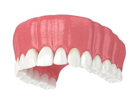 3d render of human upper jaw with black triangles Stock Illustration