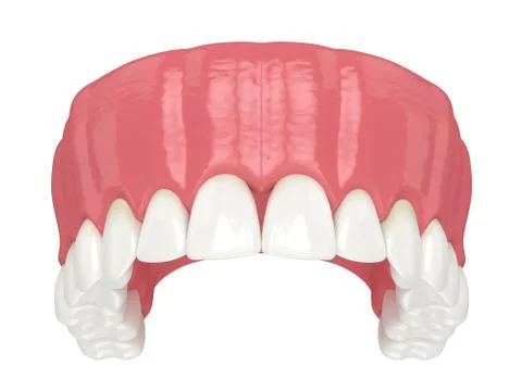 3d render of human upper jaw with black triangles Stock Illustration