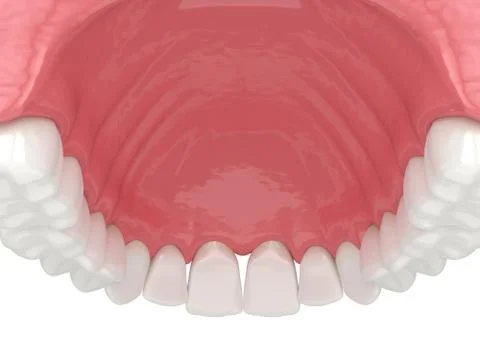 3d render of human upper jaw with black triangles Stock Illustration
