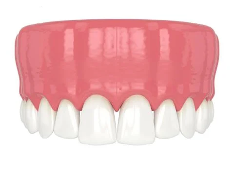 3d render of human upper jaw with black triangles Illustrazione stock