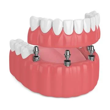 3d render of implant partial denture Illustrazione stock