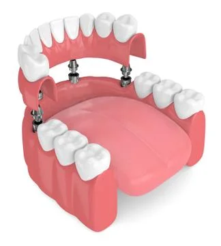 3d render of implant partial denture Illustrazione stock