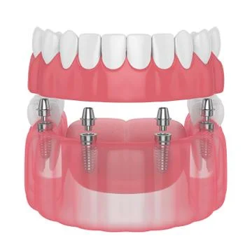 3d render of implant partial denture Stock Illustration