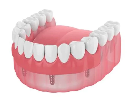 3d render of implant partial denture Illustrazione stock