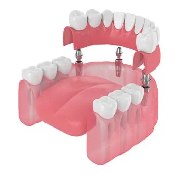 3d render of implant partial denture Illustrazione stock