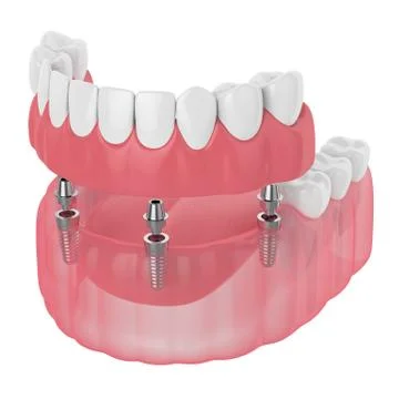 3d render of implant partial denture Illustrazione stock