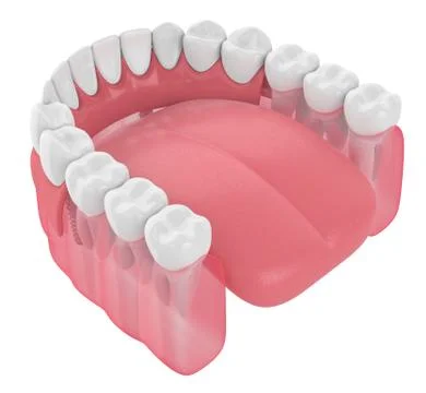 3d render of implant partial denture Stock Illustration
