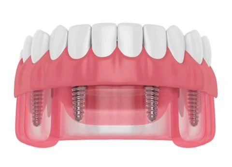 3d render of implant partial denture Illustrazione stock