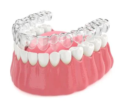 3d render of invisalign removable retainer with lower jaw Stock Photos