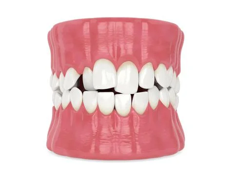 3d render of jaw with abnormal toothing position isolated over white backgrou Illustrazione stock
