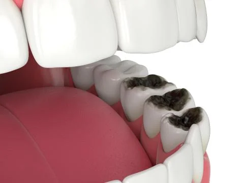 3d render of  jaw and teeth with caries Stock Illustration