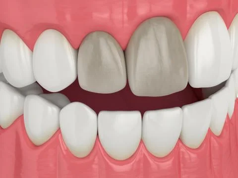3d render of jaw and teeth with dead pulp Stock Illustration