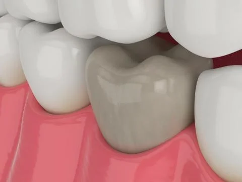 3d render of jaw and tooth with dead pulp Stock Illustration