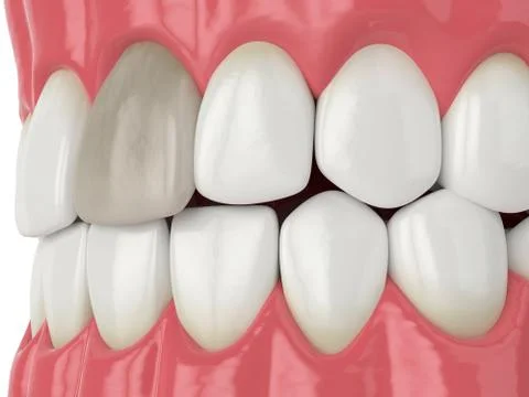 3d render of jaw and tooth with dead pulp Illustrazione stock