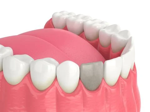 3d render of jaw and tooth with dead pulp Illustrazione stock