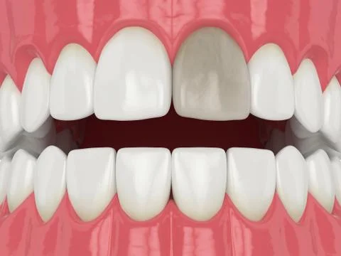 3d render of jaw and tooth with dead pulp Illustrazione stock
