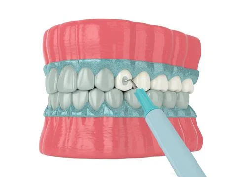 3d render of jaw with applying activating gel for teeth bleaching. Stock-Illustration