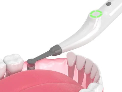 3d render of jaw with buried healing cap and smart implant detector Stock Illustration