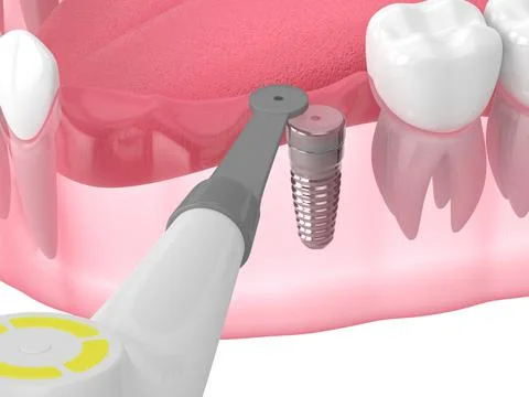 3d render of jaw with buried healing cap and smart implant detector Stock Illustration