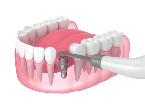 3d render of jaw with buried healing cap and smart implant detector Stock Illustration