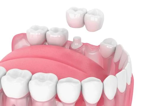 3d render of jaw with cantilever bridge Stock Illustration