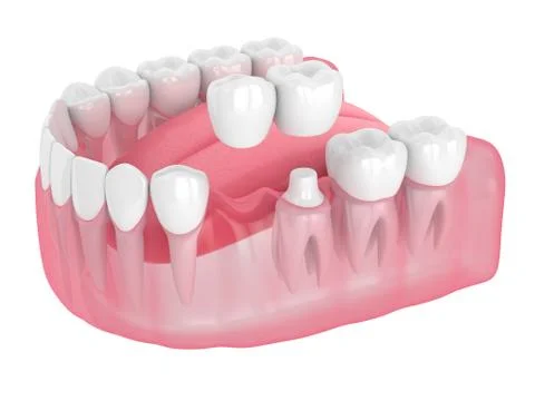 3d render of jaw with cantilever bridge Stock Illustration