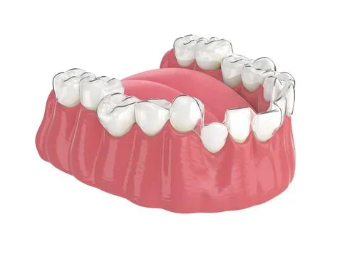 3d render of jaw with clear aligner splint Stock Illustration