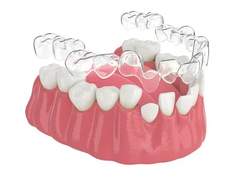 3d render of jaw with clear aligner splint Stock Illustration